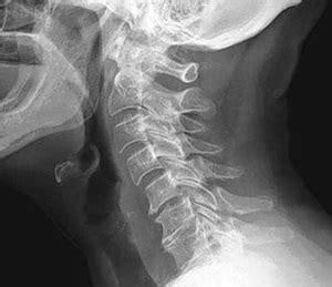 рентгенова снимка на остеохондроза на шийния отдел на гръбначния стълб
